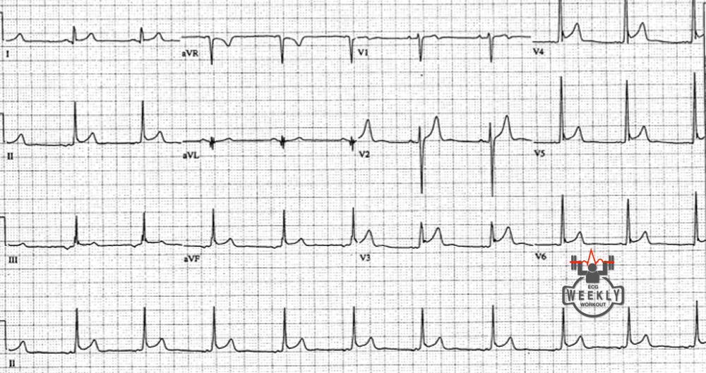 Presenting ECG — Differential Diagnoses: QT interval considerations in patients with palpitations