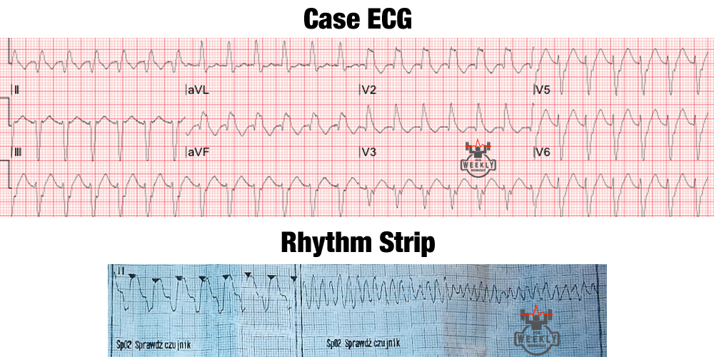 Presenting ECG — ECG Basics & Fundamentals: electrical cardioversion of an unstable regular wide complex tachycardia
