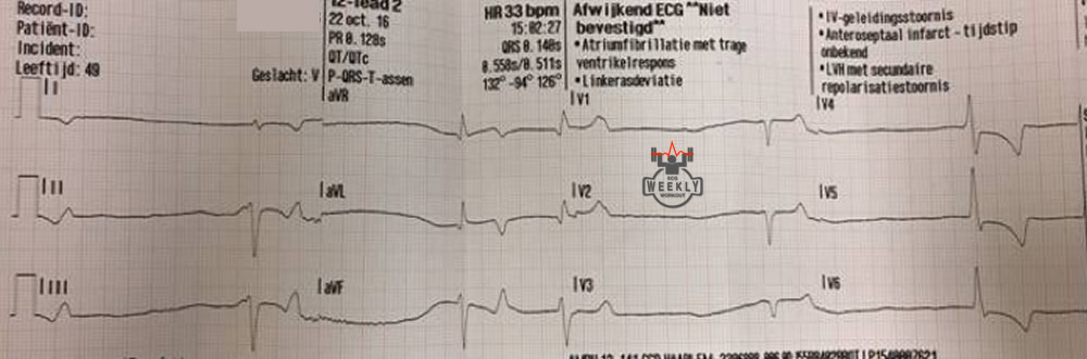 Presenting ECG — Bradyarrhthmias: considerations in unstable patients with discussion on an important causes of refractory bradycardia