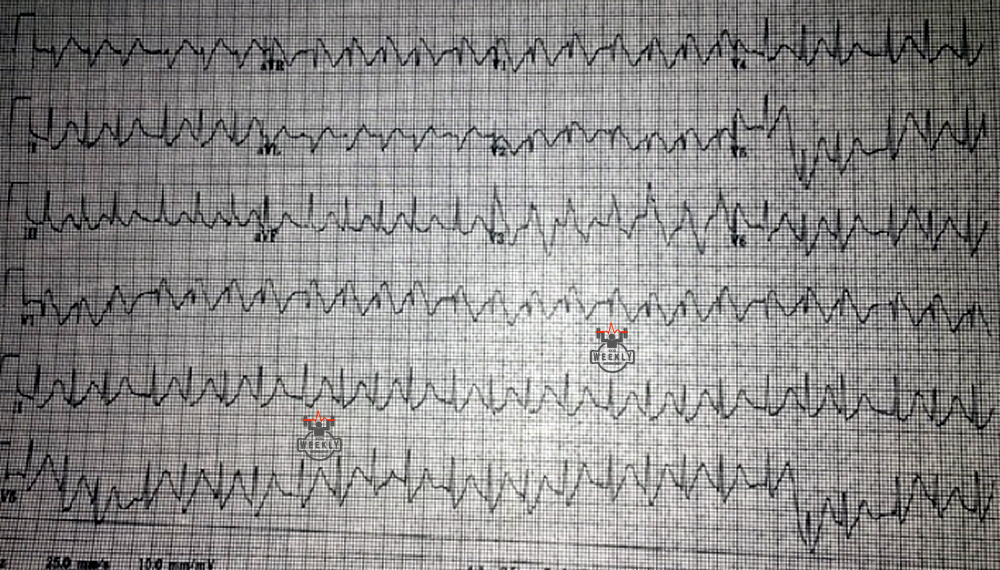 Presenting ECG — Differential Diagnoses: fever and altered mental status