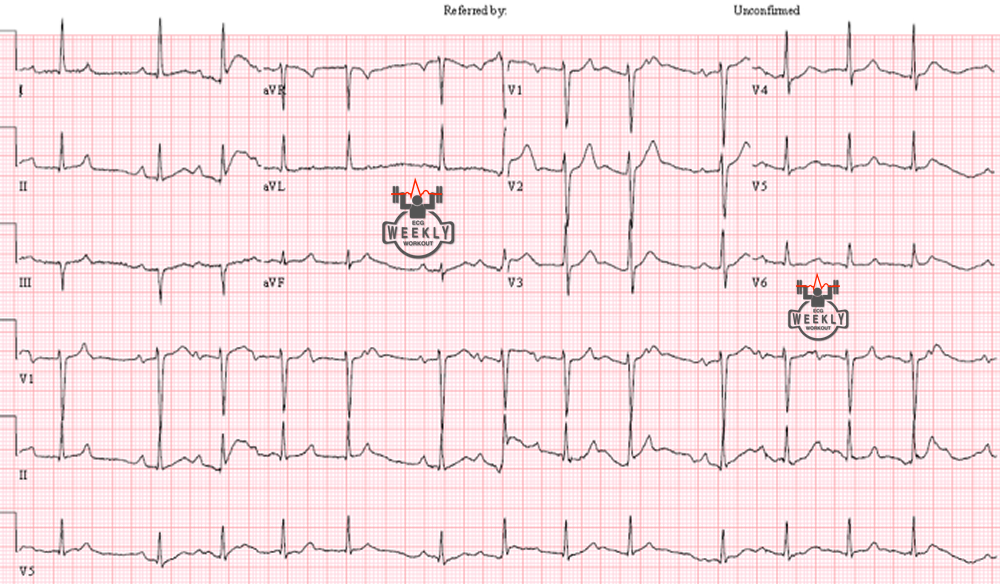 Presenting ECG — Differential Diagnoses: left axis deviation, fasicular block, and AV blocks