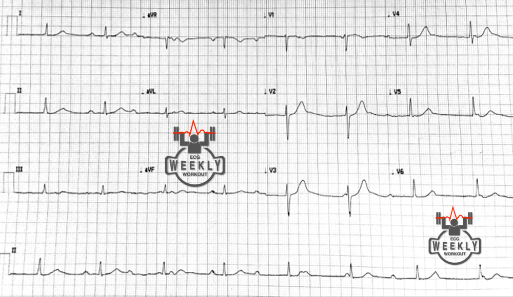 Presenting ECG — Narrow vs. wide complex QRS in patients with complete heart block