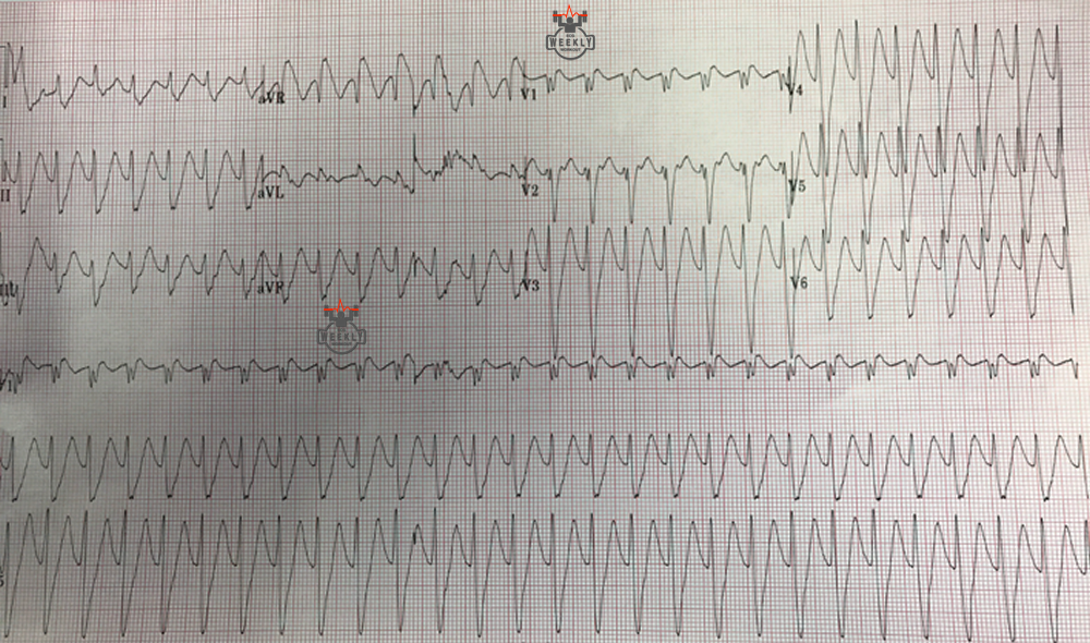 Presenting ECG — Differential Diagnoses: must know causes of wide QRS complexes