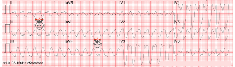 Presenting ECG — Wide Complex Tachycardias: regular wide complex tachycardia (RWCT) vs. regular REALLY wide complex tachycardia (RRWCT)