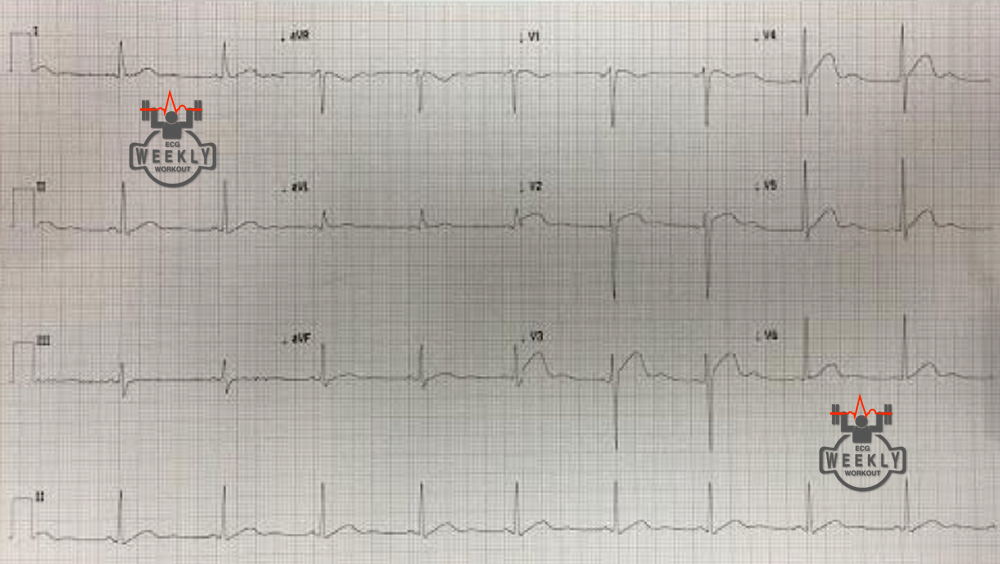 Presenting ECG — Differential Diagnoses: over 15 causes of ST segment elevation...there is much more than STEMI
