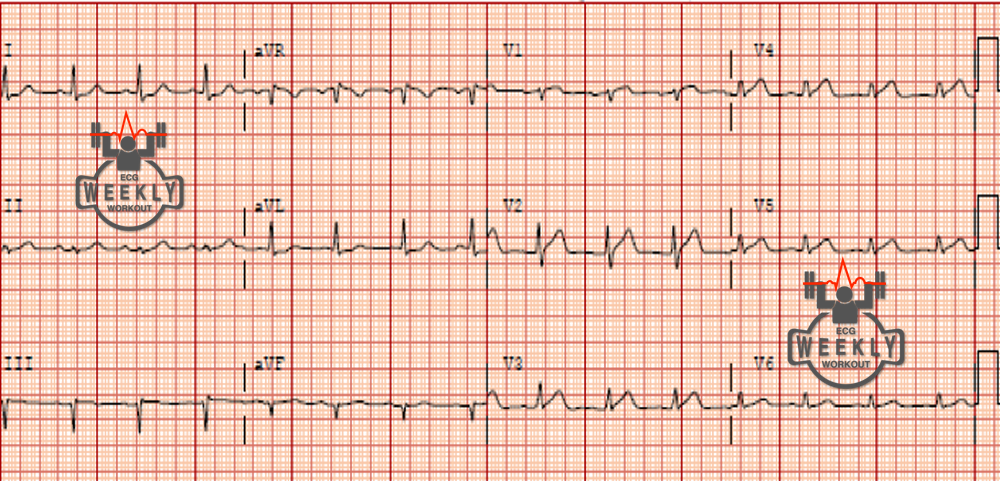 Presenting ECG — ECG Basics & Fundamentals: chest pain in young patient with no known cardiac risk factors