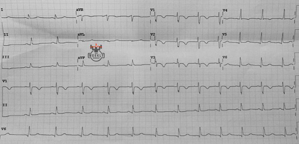 Presenting ECG — Literature Review:  Arrhythmogenic Right Ventricular Dysplasia / Cardiomyopathy
