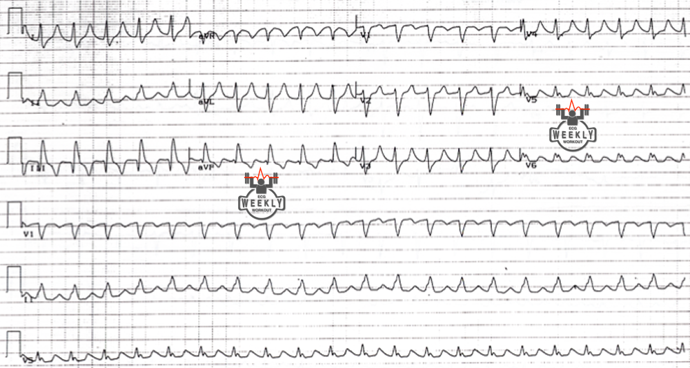 Presenting ECG — STAT ECG Diagnoses: regular wide complex tachycardia (RWCT) after succinylcholine?