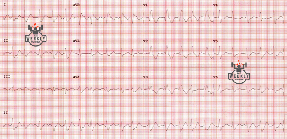 Presenting ECG — Wide Complex Tachycardias: ventricular tachycardia (VT) mimics