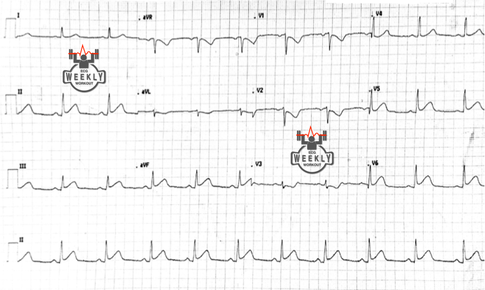 Presenting ECG — Differential Diagnoses: what do you look for when interpreting the ECG of patients with “new onset seizures”?
