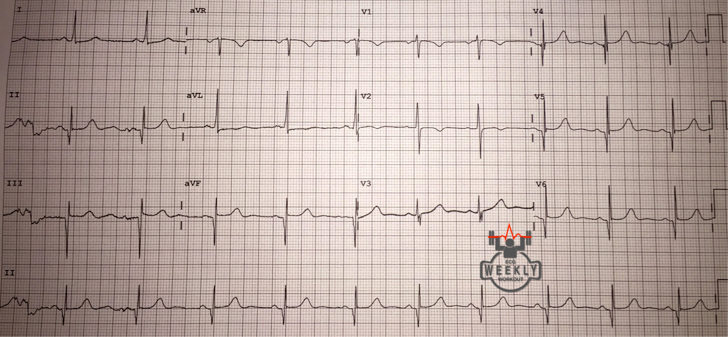Presenting ECG — Differential Diagnoses: life threatening causes of syncope
