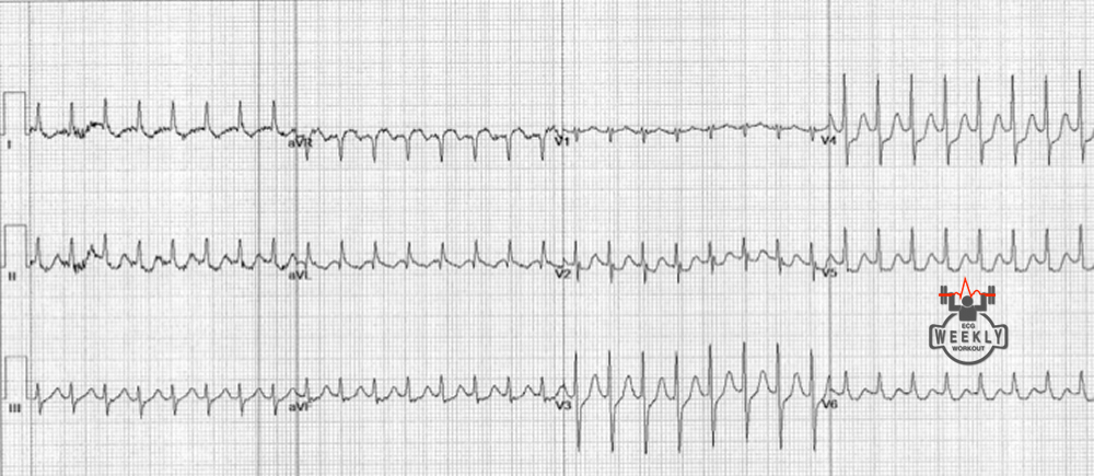 Presenting ECG — Differential Diagnoses: supraventricular tachycardia with ST segment elevation in aVR