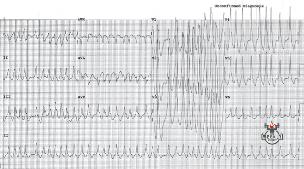 Presenting ECG — Literature Review: when are calcium channel blockers and beta blockers contraindicated in atrial fibillation