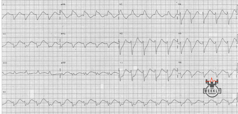 Presenting ECG — STAT ECG Diagnoses: must know ECG differentials in the evaluation of patients with altered mental status