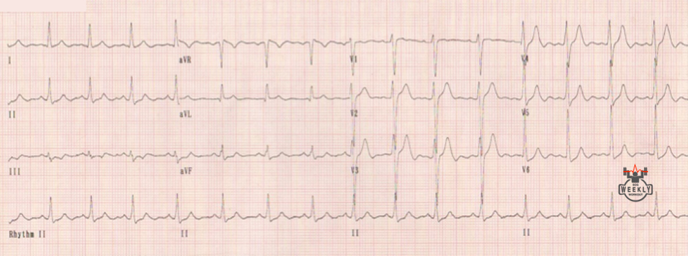 Presenting ECG — Systolic ejection murmur and notching of the R wave in the inferior leads