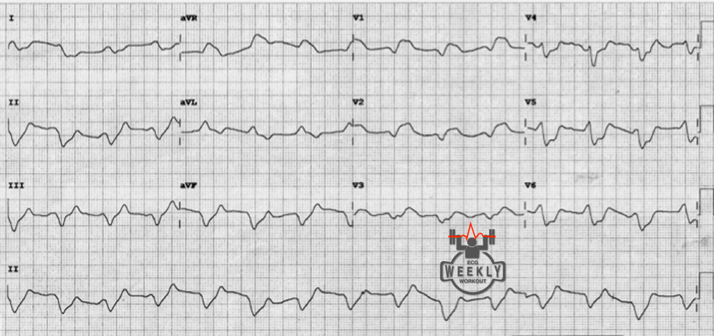 Presenting ECG — STAT ECG Diagnoses: Post-cardiac arrest ECG with this pattern, what is the most likely cause of arrest and would you activate the cath lab?