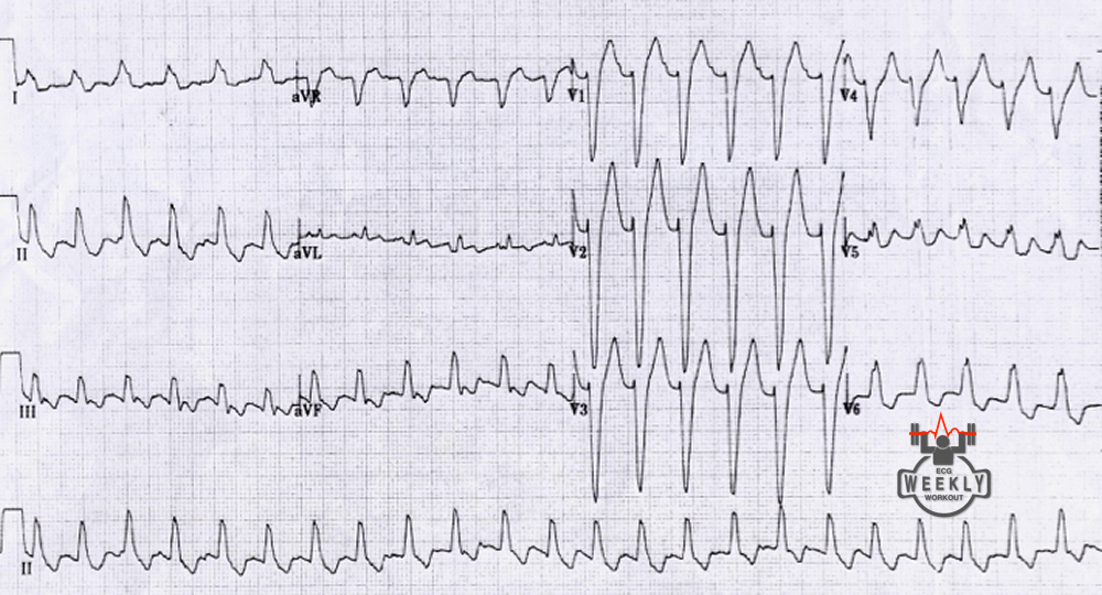 Presenting ECG — ECG Basics & Fundamentals: inspecting T waves closely, looking for buried P waves