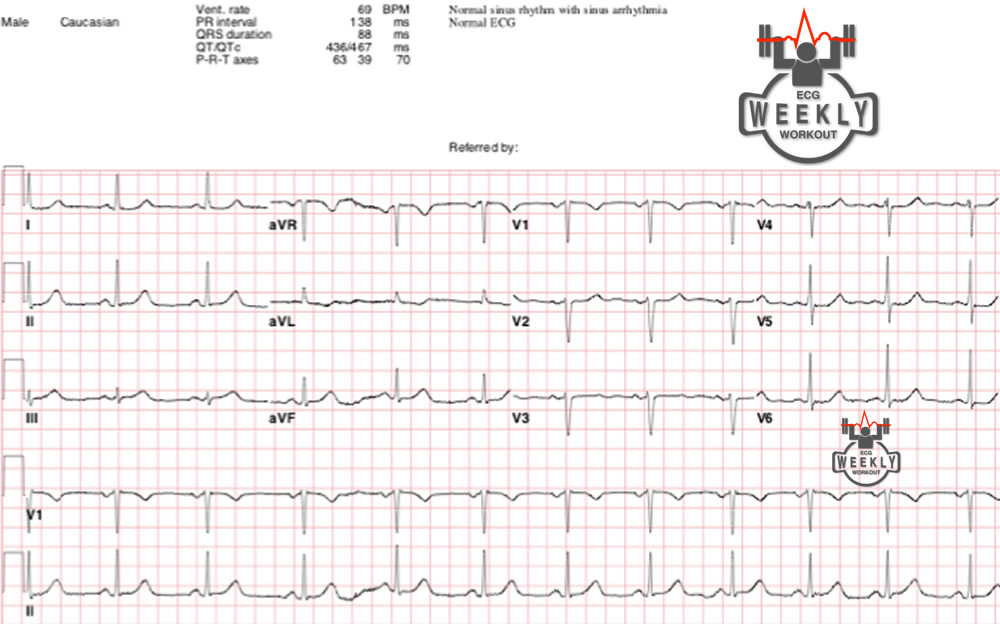 Presenting ECG — Refractory ischemic chest pain despite maximal medical management
