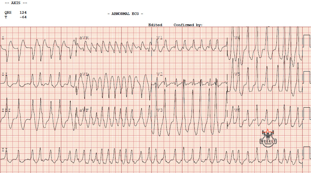 Presenting ECG — STAT ECG Diagnoses: can't miss type of wide complex irregular tachycardia