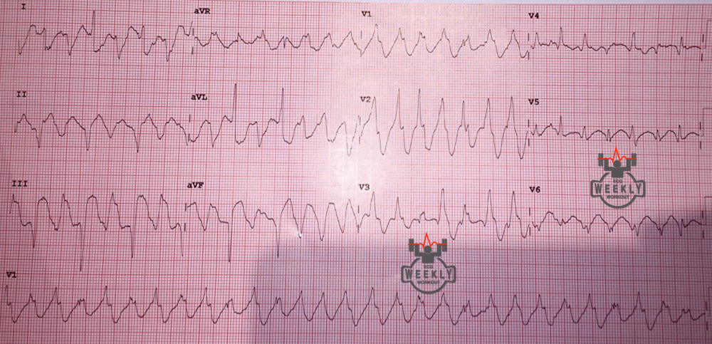 Presenting ECG — Wide Complex Tachycardias: considerations in unstable patients with discussion on an important VT mimic