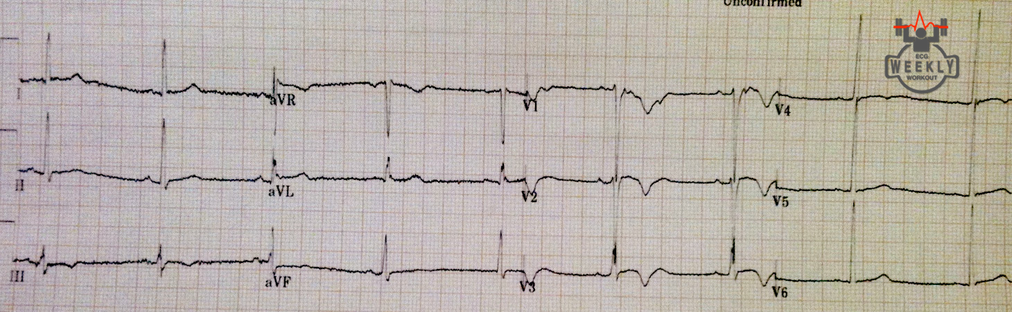 Presenting ECG — Differential Diagnoses: considerations in patients with syncope