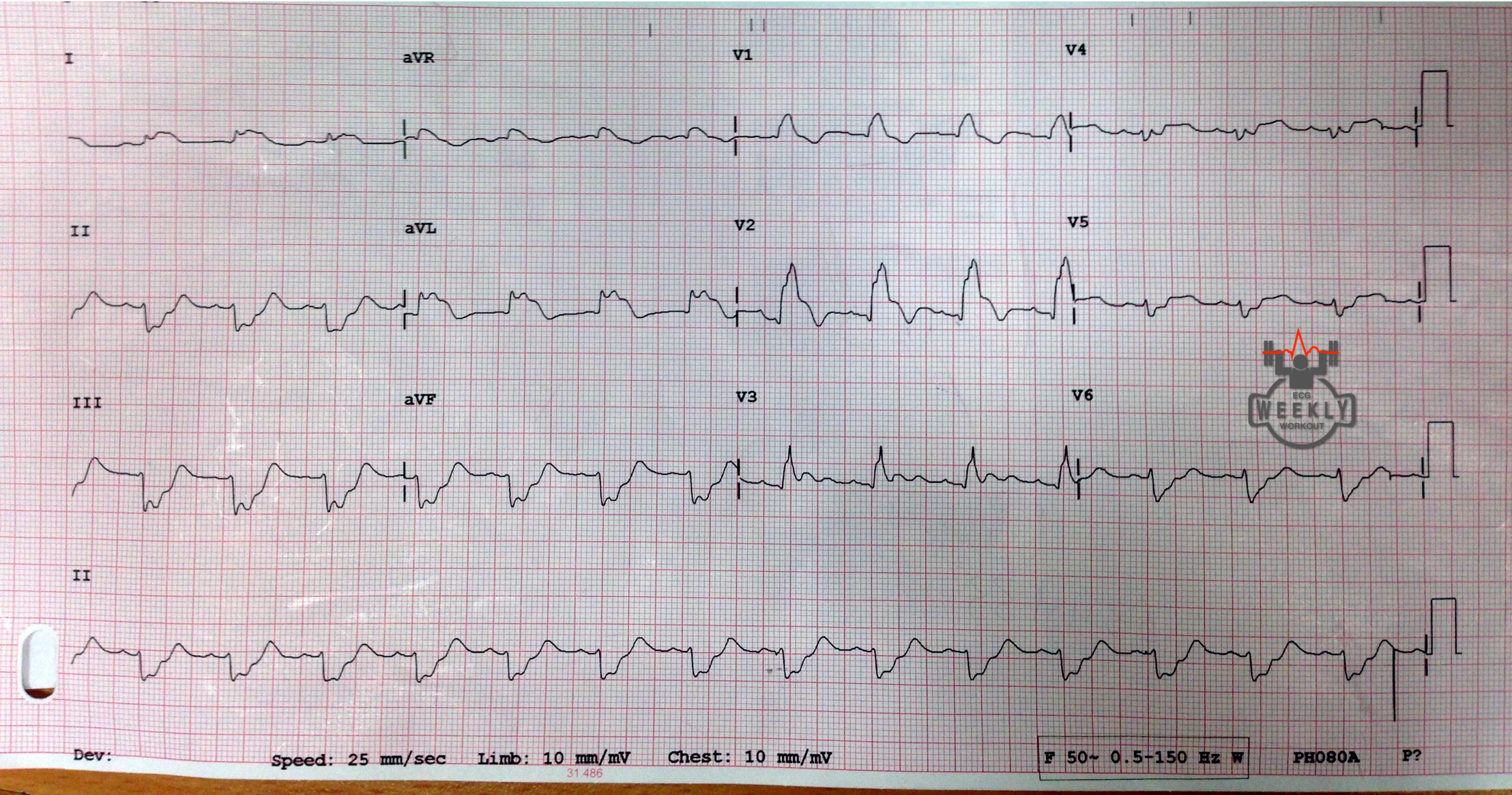 Presenting ECG — ECG Basics & Fundamentals: the value of ECGs in patients with diabetic ketoacidosis (DKA)
