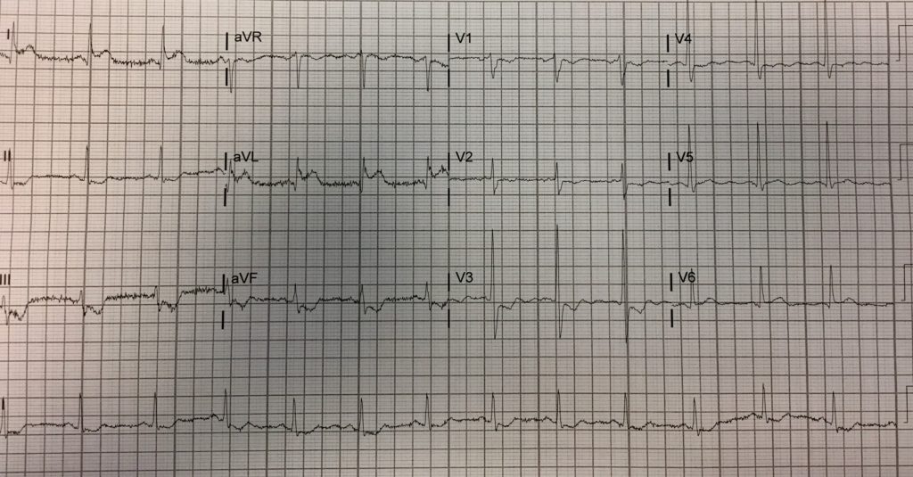 Presenting ECG — Literature Review: lumen stenosis doesn’t matter in ACS…It’s all about plaque vulnerability!