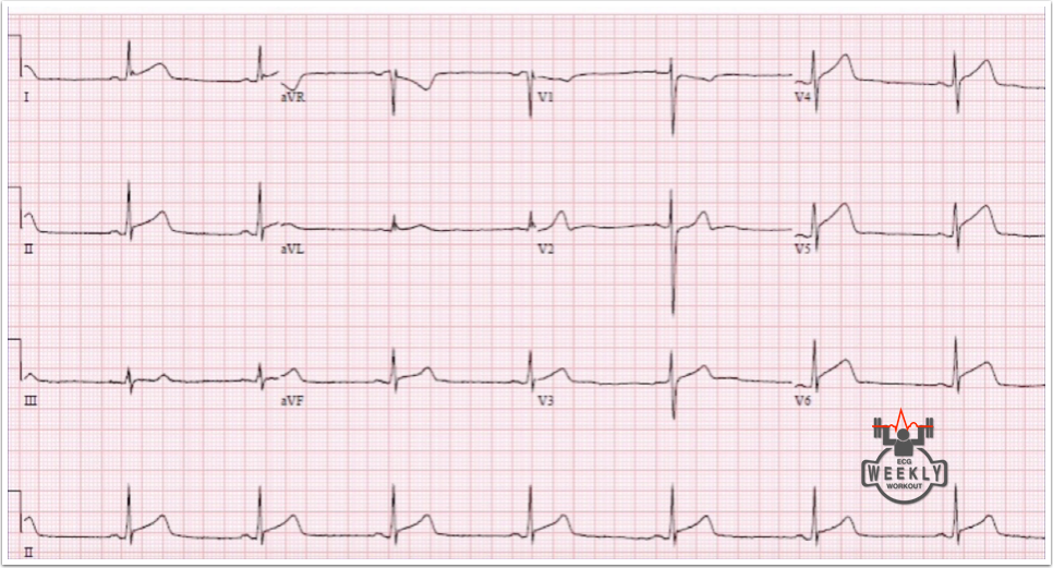 Presenting ECG — STAT ECG Diagnoses: ruling out rapidly fatal diagnoses first, before diagnosing non life threatening conditions