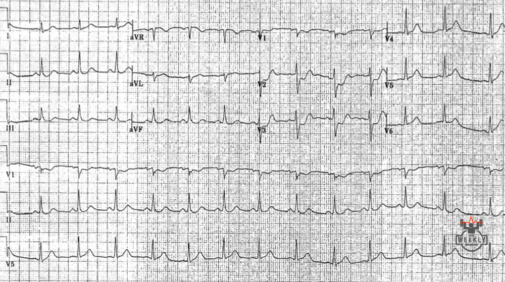 Presenting ECG — ECG Basics & Fundamentals: you don't always need ST segment elevation to benefit from acute reperfusion therapy