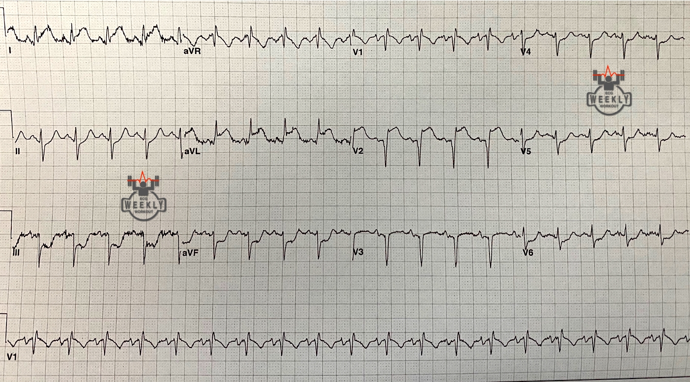 Presenting ECG — Literature Review: COVID and the Heart