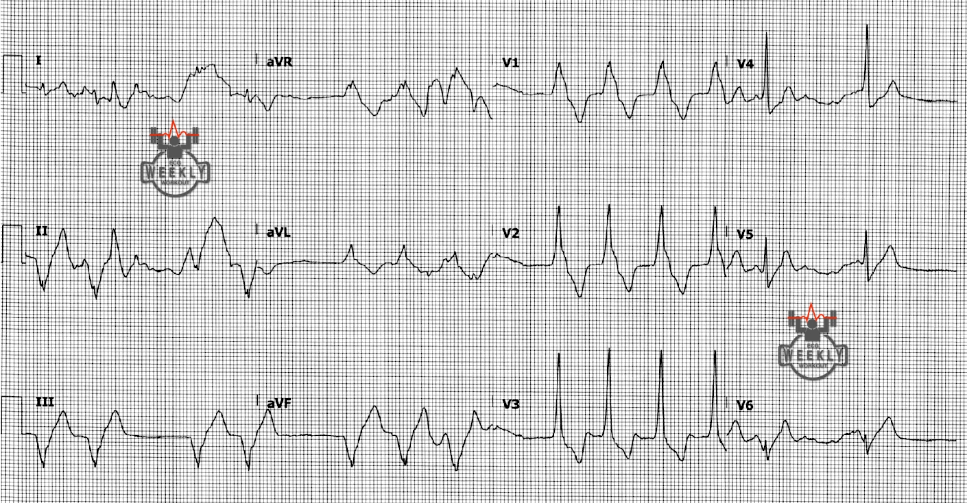 Presenting ECG — ECG Basics & Fundamentals: ventricular rhythms to be aware of in patients with cardiac ischemia