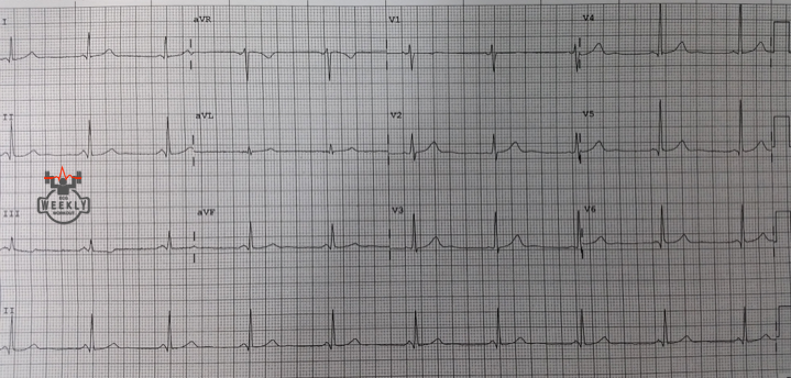 Presenting ECG — Differential Diagnoses: short PR intervals and a review of the Lown-Ganong-Levine (LGL) syndrome