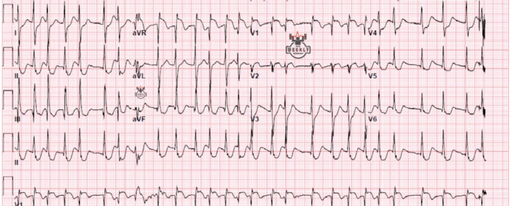 Presenting ECG — Post-cardiac arrest ECGs: can you guess the cause of arrest based off this ECG?