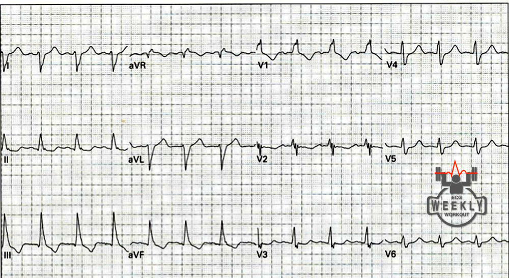 Presenting ECG — ECG Basics & Fundamentals: differentials for left and right axis deviation, and how to identify fascicular blocks