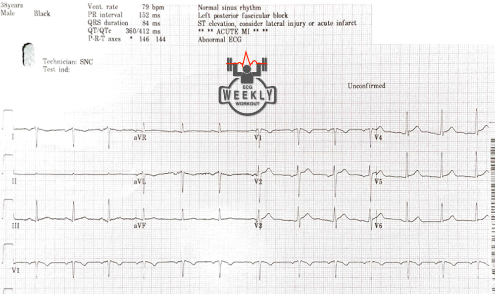 Presenting ECG — ECG Basics & Fundamentals: diagnostic criteria for acute pericarditis
