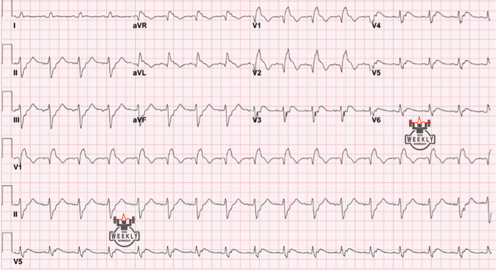 Presenting ECG — ECG Basics & Fundamentals: when does the QRS complex end and the ST segment begin in RBBB