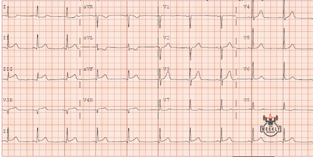 Presenting ECG — Nothing will drop risk to zero in the evaluation of ACS