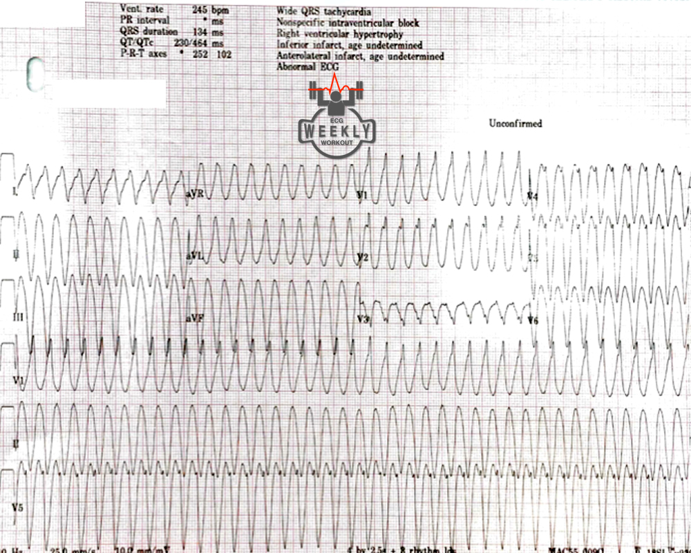 Presenting ECG — The perfect wide complex tachycardia algorithm...does not exist!