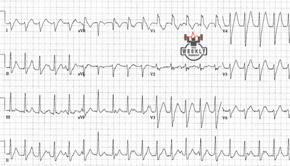 Presenting ECG — Does response to adenosine rule out ventricular tachycardia?