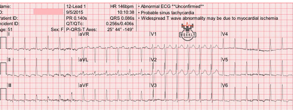 Presenting ECG — Differential Diagnoses: the main three things that cause narrow complex regular tachycardias