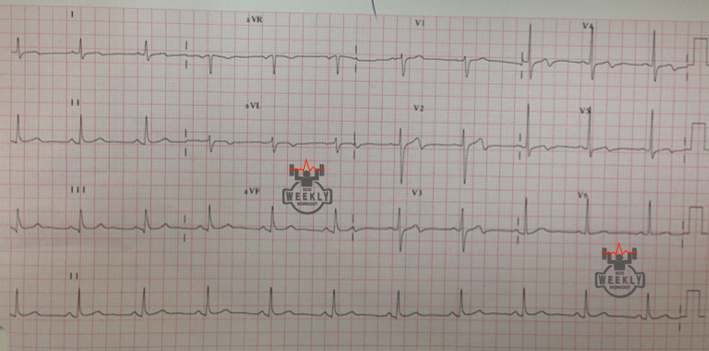 Presenting ECG — Literature Review: Wellens syndrome