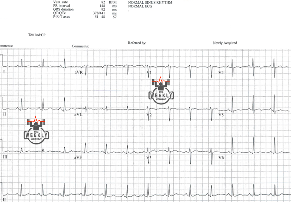Presenting ECG — Literature Review: does GERD provoke myocardial ischemia in patients with coronary artery disease?