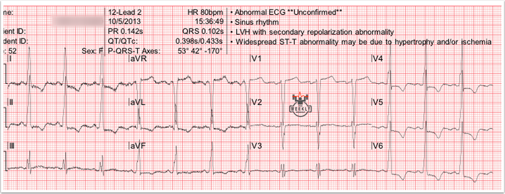 Presenting ECG — Differential Diagnoses: LVH with strain pattern vs. acute cardiac Ischemia