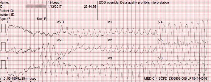 Presenting ECG — EMS ECGs: ventricular tachycardia (VT) pearls and pitfalls