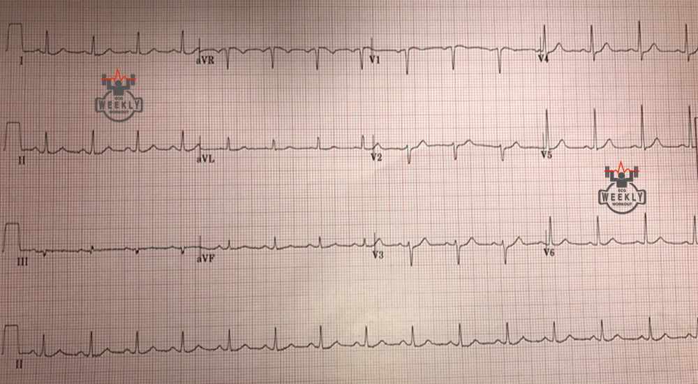 Presenting ECG — Literature Review: what do you do when ST-segment elevation in STEMI resolves before cath lab activation