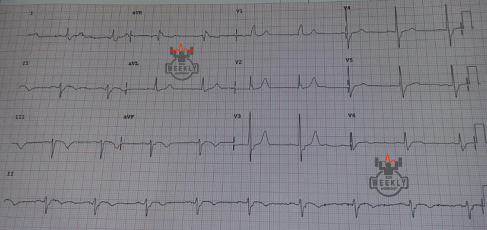 Presenting ECG — ECG Basics & Fundamentals: pseudo ST segment elevation in patients with bundle branch blocks