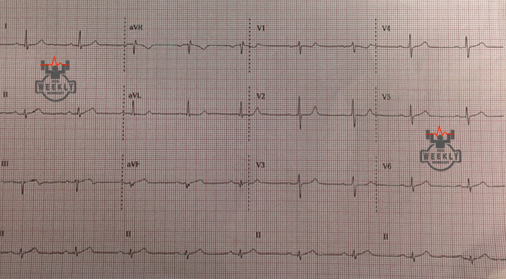 Presenting ECG — STAT ECG Diagnoses: earliest ECG findings of cardiac ischemia