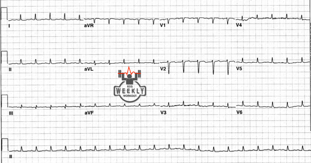 Presenting ECG — ECG Basics & Fundamentals: electrical alternans is present in less than 1/3 of patients with proven cardiac tamponade