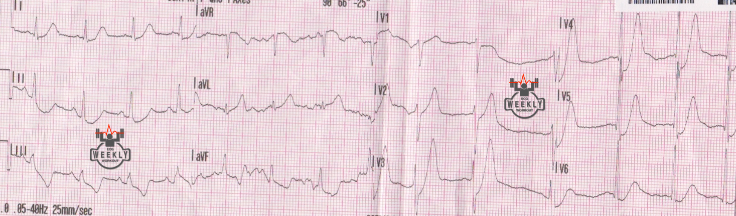 Presenting ECG — Literature Review: De Winter T waves