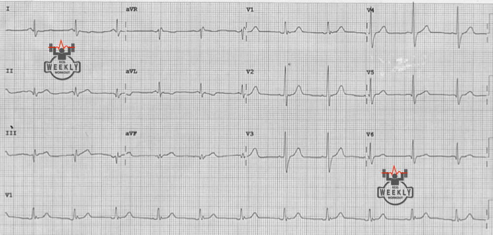 Presenting ECG — Literature Review: outcomes for patients with STEMI presenting with nondiagnostic initial ECGs